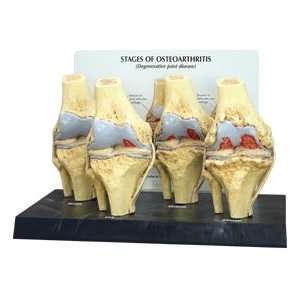  4 Stage Osteoarthritis Model Industrial & Scientific