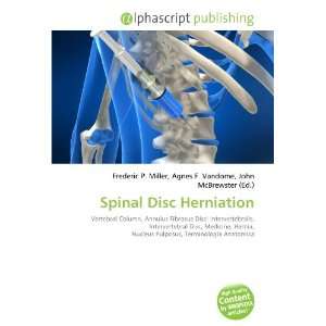  Spinal Disc Herniation (9786134069410) Books