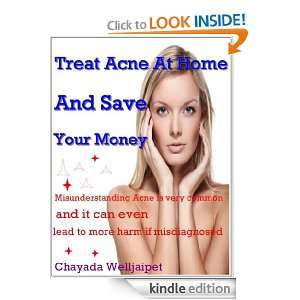 Treat Acne At Home And Save Your Money Misunderstanding Acne Is Very 